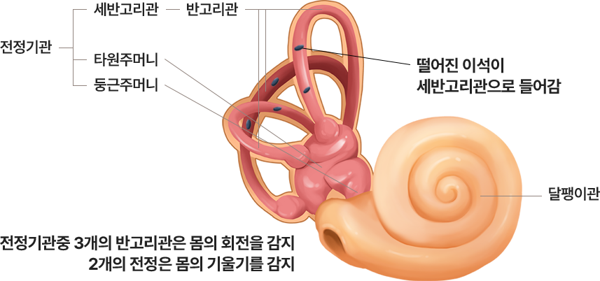 떨어진 이석이 세반고리관으로 들어감. 전정기관중 3개의 반고리관은 몸의 회전을 감지, 2개의 전정은 몸의 기울기를 감지